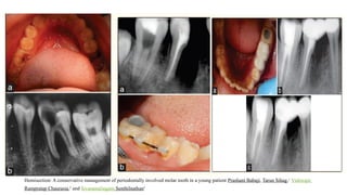 Hemisection: A conservative management of periodontally involved molar tooth in a young patient Prashant Babaji, Tarun Sihag,1
Vishwajit
Rampratap Chaurasia,2
and Sivaramalingam Senthilnathan3
 