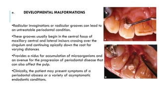 e. DEVELOPMENTAL MALFORMATIONS
•Radicular invaginations or radicular grooves can lead to
an untreatable periodontal condition.
•These grooves usually begin in the central fossa of
maxillary central and lateral incisors crossing over the
cingulum and continuing apically down the root for
varying distances
•Provides a nidus for accumulation of microorganisms and
an avenue for the progression of periodontal disease that
can also affect the pulp.
•Clinically, the patient may present symptoms of a
periodontal abscess or a variety of asymptomatic
endodontic conditions.
 