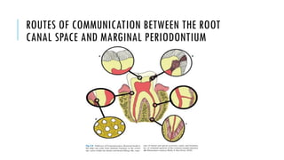 ROUTES OF COMMUNICATION BETWEEN THE ROOT
CANAL SPACE AND MARGINAL PERIODONTIUM
 