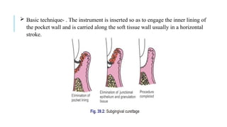  Basic technique- . The instrument is inserted so as to engage the inner lining of
the pocket wall and is carried along the soft tissue wall usually in a horizontal
stroke.
 