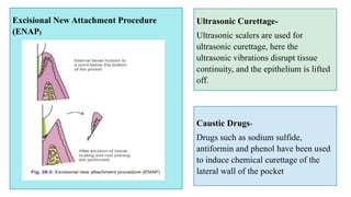 Excisional New Attachment Procedure
(ENAP)
Caustic Drugs-
Drugs such as sodium sulfide,
antiformin and phenol have been used
to induce chemical curettage of the
lateral wall of the pocket.
Ultrasonic Curettage-
Ultrasonic scalers are used for
ultrasonic curettage, here the
ultrasonic vibrations disrupt tissue
continuity, and the epithelium is lifted
off.
 