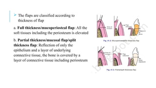  The flaps are classified according to
thickness of flap
a. Full thickness/mucoperiosteal flap: All the
soft tissues including the periosteum is elevated
b. Partial thickness/mucosal flap/split
thickness flap: Reflection of only the
epithelium and a layer of underlying
connective tissue, the bone is covered by a
layer of connective tissue including periosteum
 