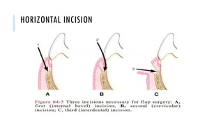 HORIZONTAL INCISION
 