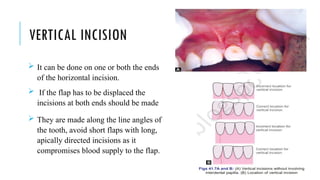 VERTICAL INCISION
 It can be done on one or both the ends
of the horizontal incision.
 If the flap has to be displaced the
incisions at both ends should be made
 They are made along the line angles of
the tooth, avoid short flaps with long,
apically directed incisions as it
compromises blood supply to the flap.
 