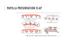 PAPILLA PRESERVATION FLAP
 
