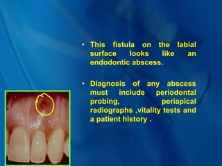 • This fistula on the labial
surface looks like an
endodontic abscess.
• Diagnosis of any abscess
must include periodontal
probing, periapical
radiographs ,vitality tests and
a patient history .
 