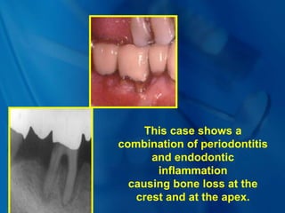 This case shows a
combination of periodontitis
and endodontic
inflammation
causing bone loss at the
crest and at the apex.
 