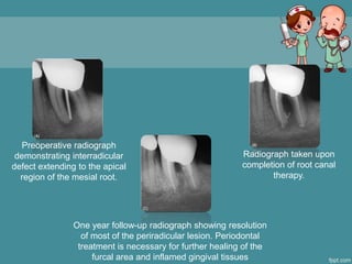 Endo-Perio.ppt