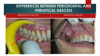 endo perio relationship in prosthodontic | PPTX