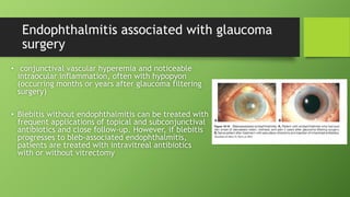 Kuliah Infeksi Imunologi : ENDOPHTALMITIS.pptx