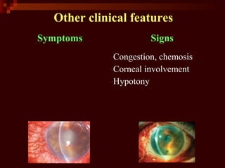 Other clinical features
Symptoms Signs
-Congestion, chemosis
-Corneal involvement
-Hypotony
 