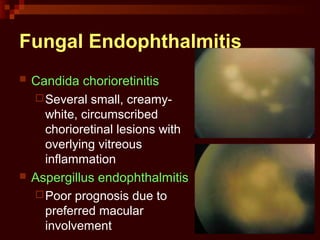 Fungal Endophthalmitis
 Candida chorioretinitis
Several small, creamy-
white, circumscribed
chorioretinal lesions with
overlying vitreous
inflammation
 Aspergillus endophthalmitis
Poor prognosis due to
preferred macular
involvement
 
