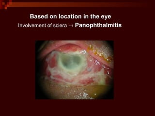 Based on location in the eye
Involvement of sclera → Panophthalmitis
 