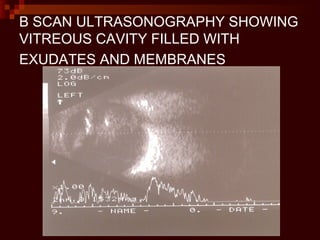 B SCAN ULTRASONOGRAPHY SHOWING
VITREOUS CAVITY FILLED WITH
EXUDATES AND MEMBRANES
 