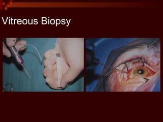 Vitreous Biopsy
 