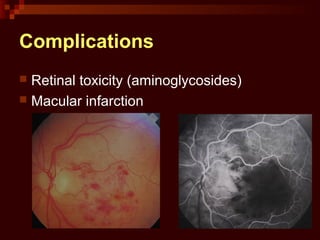 Complications
 Retinal toxicity (aminoglycosides)
 Macular infarction
 
