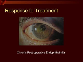 Response to Treatment
Chronic Post-operative Endophthalmitis
 