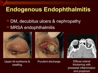 Diffuse scleral
thickening with
preseptal inflammation
and proptosis
Endogenous Endophthalmitis
 DM, decubitus ulcers & nephropathy
 MRSA endophthalmitis
Upper lid erythema &
swelling
Purulent discharge
 