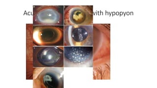 Acute endophthalmitis with hypopyon
 