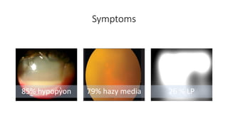 Symptoms
85% hypopyon 79% hazy media 26 % LP
 