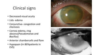 Clinical signs
• Decreased visual acuity
• Lids- edema
• Conjunctiva- congestion and
chemosis
• Cornea edema, ring
abscess(Pseudomonas and
Bacillus)
• Anterior chambercells and flare
• Hypopyon (in 86%patients in
EVS)
 