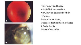 • Iris muddy and boggy
• Pupil-fibrinous exudate
• IOL-may be covered by fibrin
• Fundus-
 vitreous exudates,
scattered retinal haemorrhages
Periphlebitis
 loss of red reflex
 
