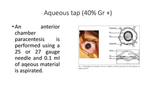 Aqueous tap (40% Gr +)
• An anterior
chamber
paracentesis is
performed using a
25 or 27 gauge
needle and 0.1 ml
of aqeous material
is aspirated.
 