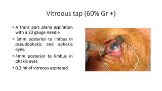 Vitreous tap (60% Gr +)
• A trans pars plana aspiration
with a 23 gauge needle
• 3mm posterior to limbus in
pseudophakic and aphakic
eyes.
• 4mm posterior to limbus in
phakic eyes
• 0.2 ml of vitreous aspirated.
 