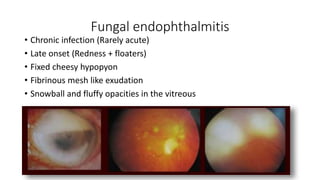 Fungal endophthalmitis
• Chronic infection (Rarely acute)
• Late onset (Redness + floaters)
• Fixed cheesy hypopyon
• Fibrinous mesh like exudation
• Snowball and fluffy opacities in the vitreous
 