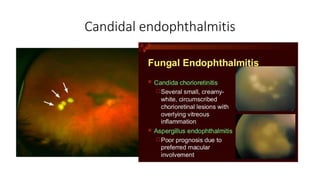 Candidal endophthalmitis
• The two most characteristic
1. creamy white, well
circumscribed chorioretinal
lesions , most common in the
posterior pole
2. yellow or white fluffy vitreous
opacities.
“string of pearls”
 