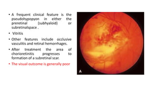 • A frequent clinical feature is the
pseudohypopyon in either the
preretinal (subhyaloid) or
subretinalspace .
• Vitritis
• Other features include occlusive
vasculitis and retinal hemorrhages.
• After treatment the area of
chorioretinitis progresses to
formation of a subretinal scar.
• The visual outcome is generally poor
 