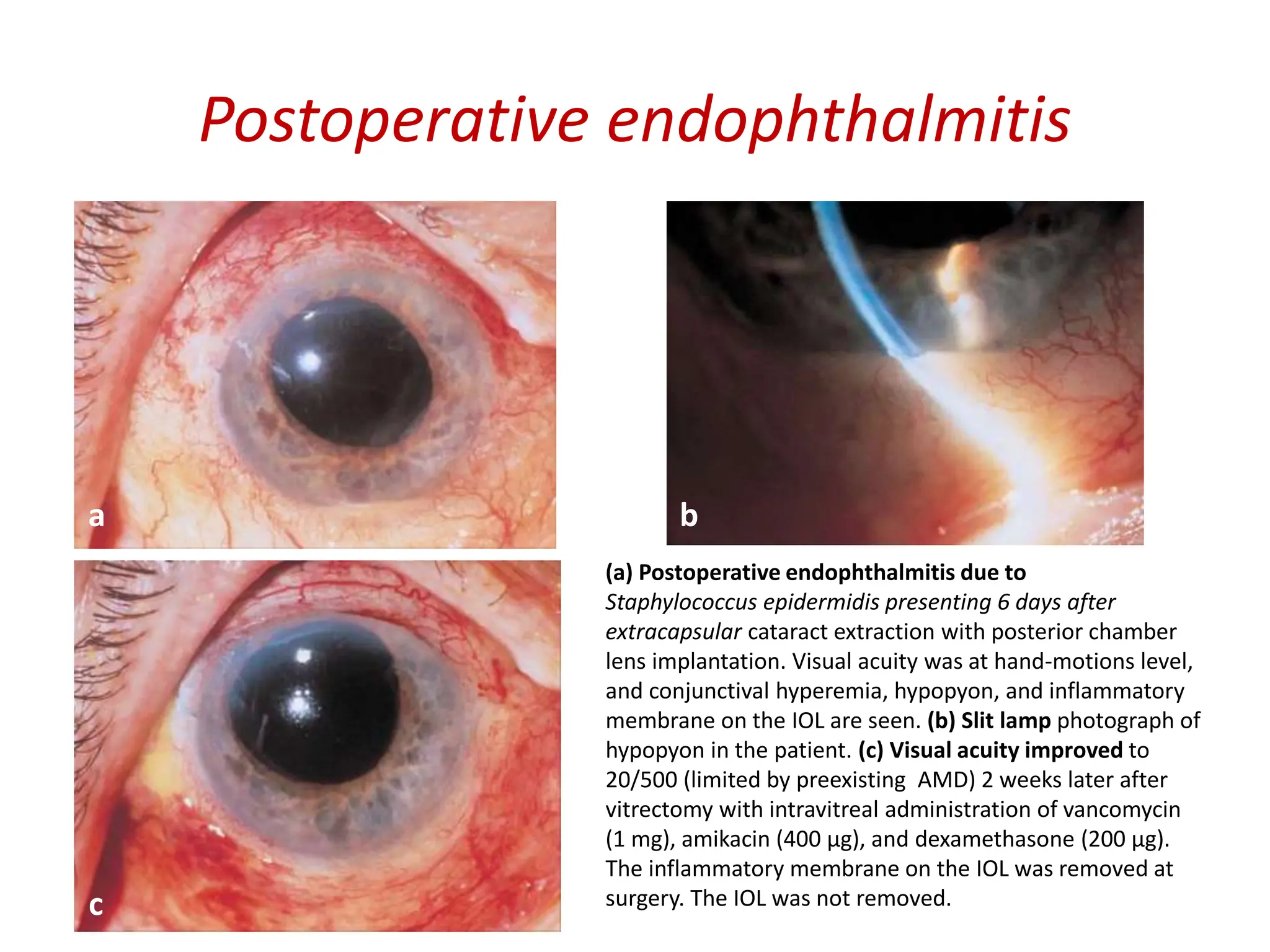 Postoperative endophthalmitis
(a) Postoperative endophthalmitis due to
Staphylococcus epidermidis presenting 6 days after
extracapsular cataract extraction with posterior chamber
lens implantation. Visual acuity was at hand-motions level,
and conjunctival hyperemia, hypopyon, and inflammatory
membrane on the IOL are seen. (b) Slit lamp photograph of
hypopyon in the patient. (c) Visual acuity improved to
20/500 (limited by preexisting AMD) 2 weeks later after
vitrectomy with intravitreal administration of vancomycin
(1 mg), amikacin (400 µg), and dexamethasone (200 µg).
The inflammatory membrane on the IOL was removed at
surgery. The IOL was not removed.
a b
c
 