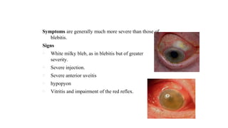 endophthalmitis Denis kamara.pptx