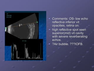  Comments: OS- low echo
reflective inferior vit
opacities, retina on.
 high reflective spot seen
superior(mid) vit cavity
with severe reverberating
echos.
 ?Air bubble. ???IOFB.
 