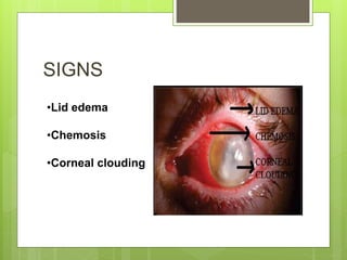 SIGNS
•Lid edema
•Chemosis
•Corneal clouding
 