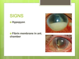 SIGNS
 Hypopyon
 Fibrin membrane in ant.
chamber
 