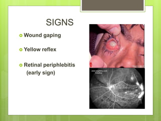 SIGNS
 Wound gaping
 Yellow reflex
 Retinal periphlebitis
(early sign)
 