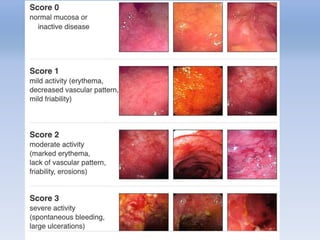 ENDOSCOPY ROLE IN INFLAMMATORY BOWEL DISEASE, ENDOSCOPY HISORY | PPTX