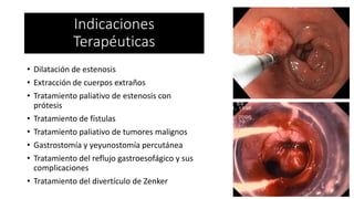 • Dilatación de estenosis
• Extracción de cuerpos extraños
• Tratamiento paliativo de estenosis con
prótesis
• Tratamiento de fístulas
• Tratamiento paliativo de tumores malignos
• Gastrostomía y yeyunostomía percutánea
• Tratamiento del reflujo gastroesofágico y sus
complicaciones
• Tratamiento del divertículo de Zenker
Indicaciones
Terapéuticas
 