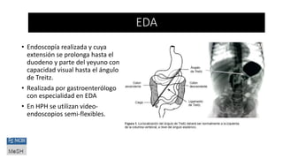 • Endoscopía realizada y cuya
extensión se prolonga hasta el
duodeno y parte del yeyuno con
capacidad visual hasta el ángulo
de Treitz.
• Realizada por gastroenterólogo
con especialidad en EDA
• En HPH se utilizan video-
endoscopios semi-flexibles.
EDA
 