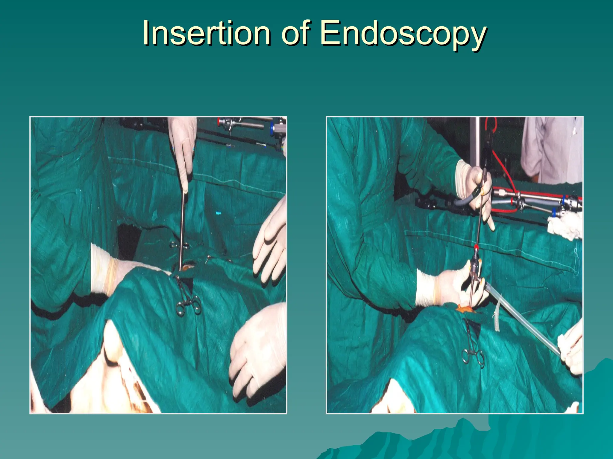 Insertion of Endoscopy
Insertion of Endoscopy
 