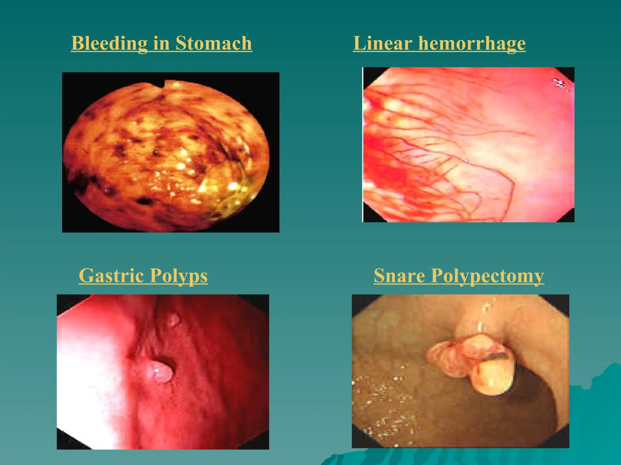 Bleeding in Stomach Linear hemorrhage
Gastric Polyps Snare Polypectomy
 