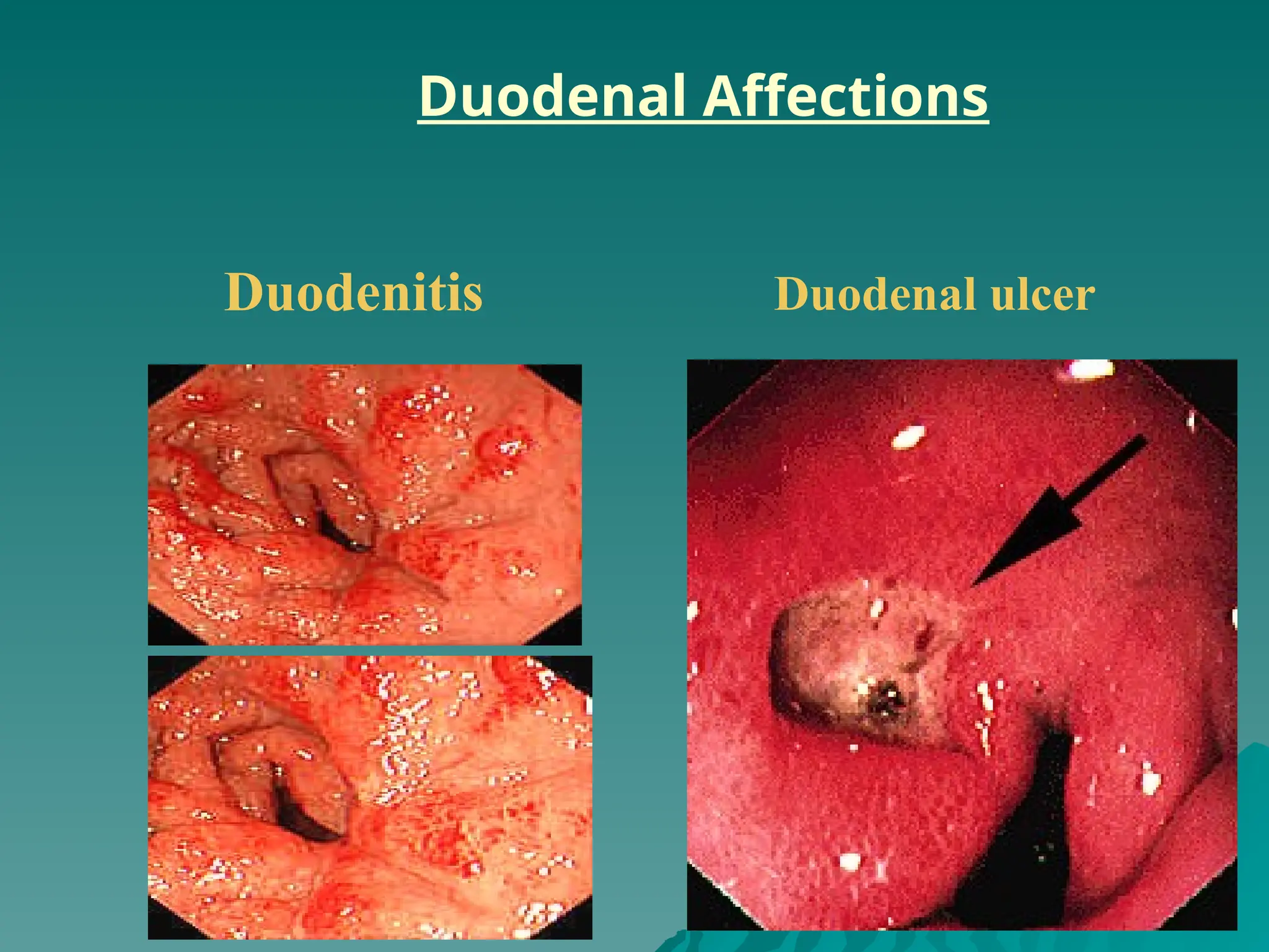 Duodenal ulcer
Duodenitis
Duodenal Affections
 
