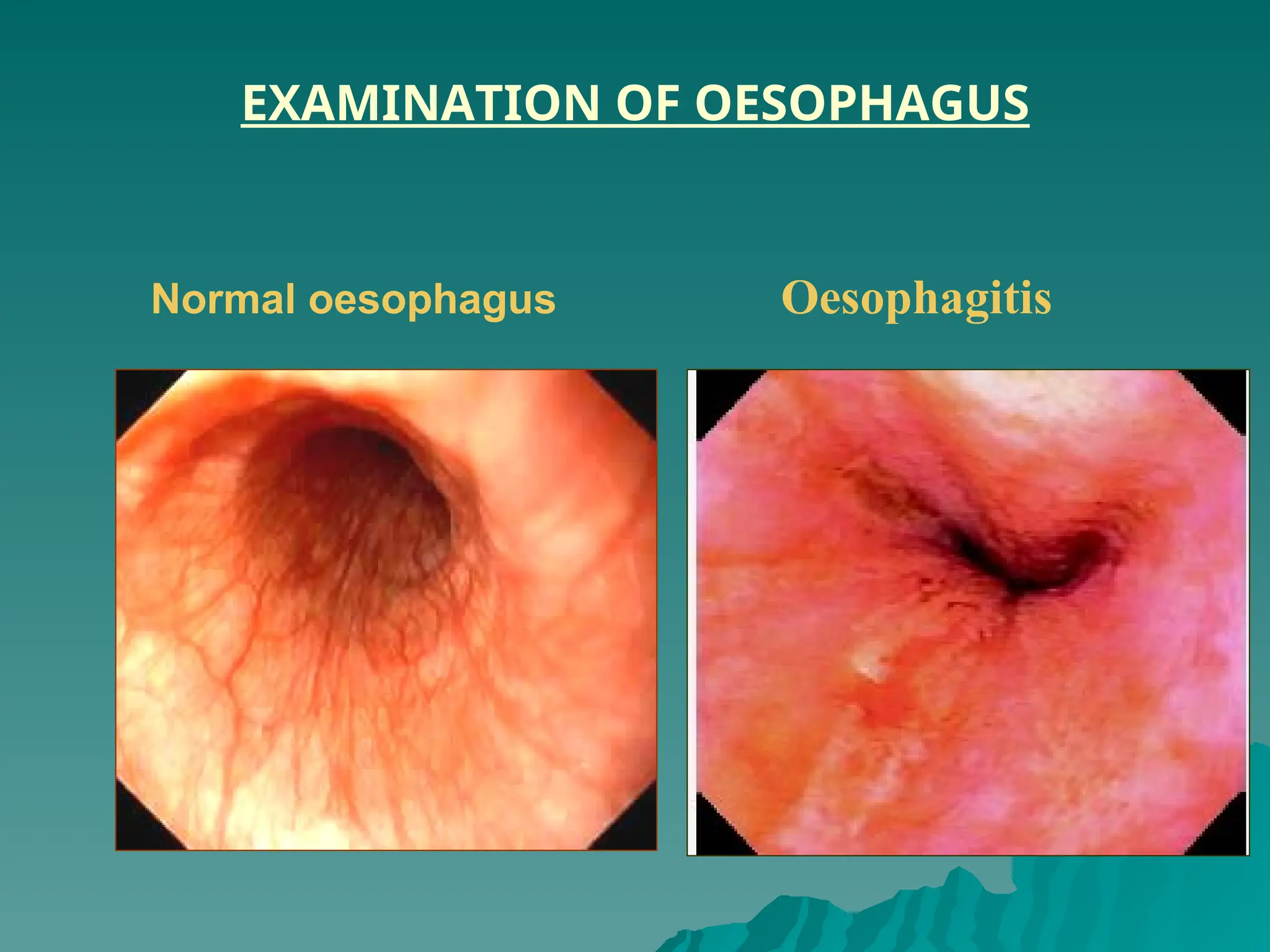 EXAMINATION OF OESOPHAGUS
Normal oesophagus Oesophagitis
 
