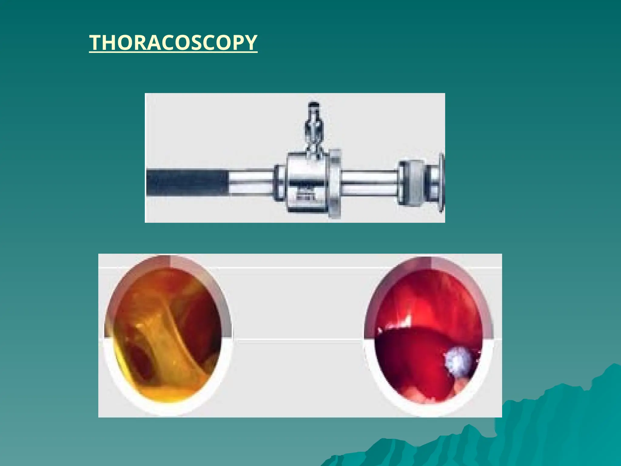 THORACOSCOPY
 