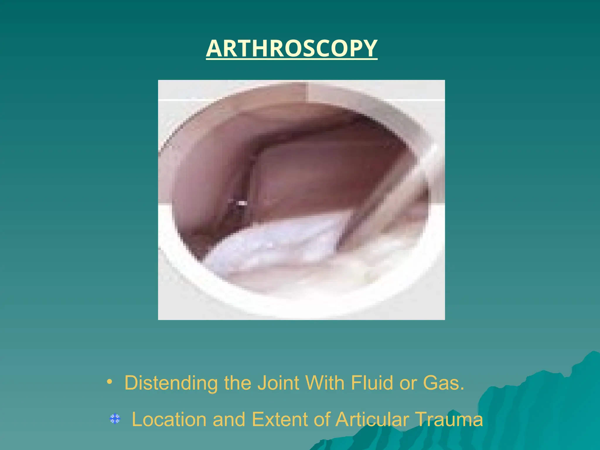 • Distending the Joint With Fluid or Gas.
Location and Extent of Articular Trauma
ARTHROSCOPY
 