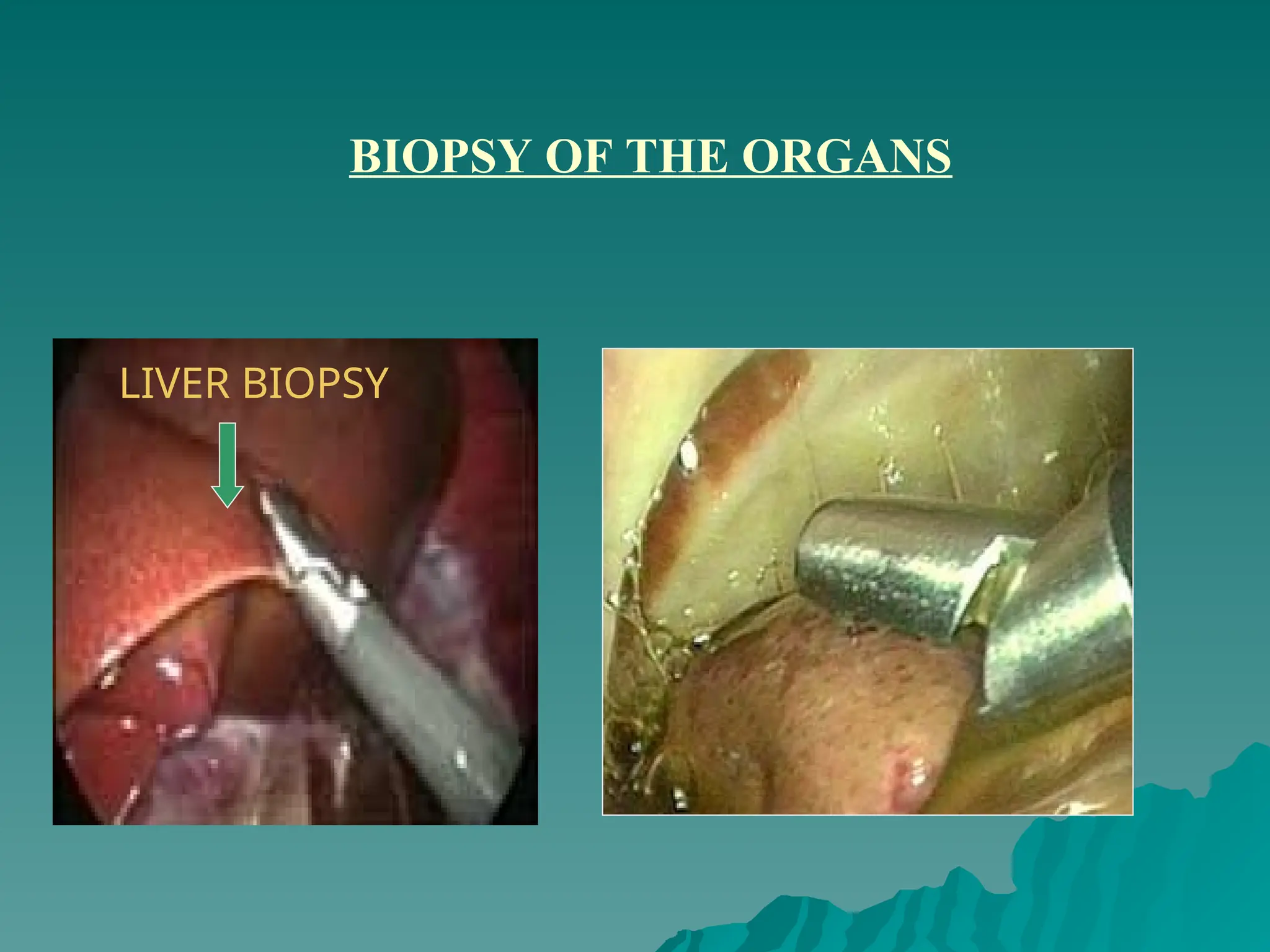 BIOPSY OF THE ORGANS
LIVER BIOPSY
 