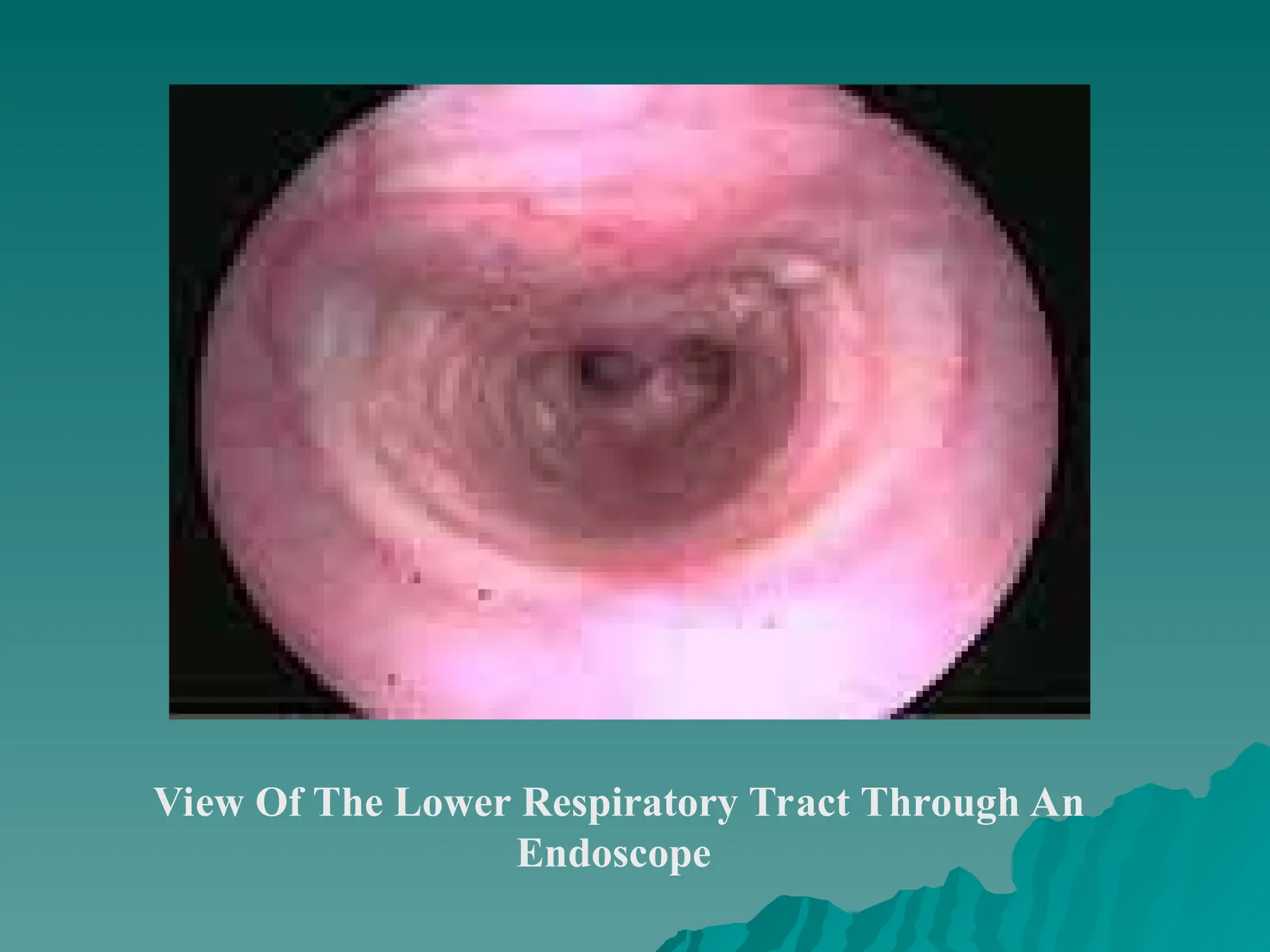 View Of The Lower Respiratory Tract Through An
Endoscope
 