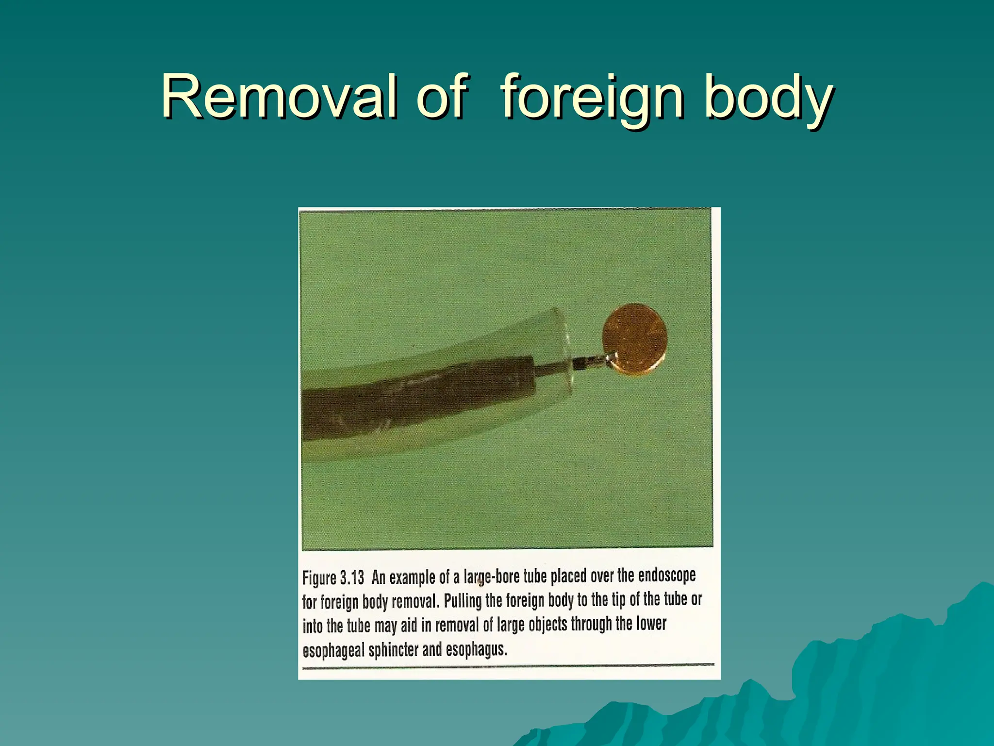 Removal of foreign body
Removal of foreign body
 