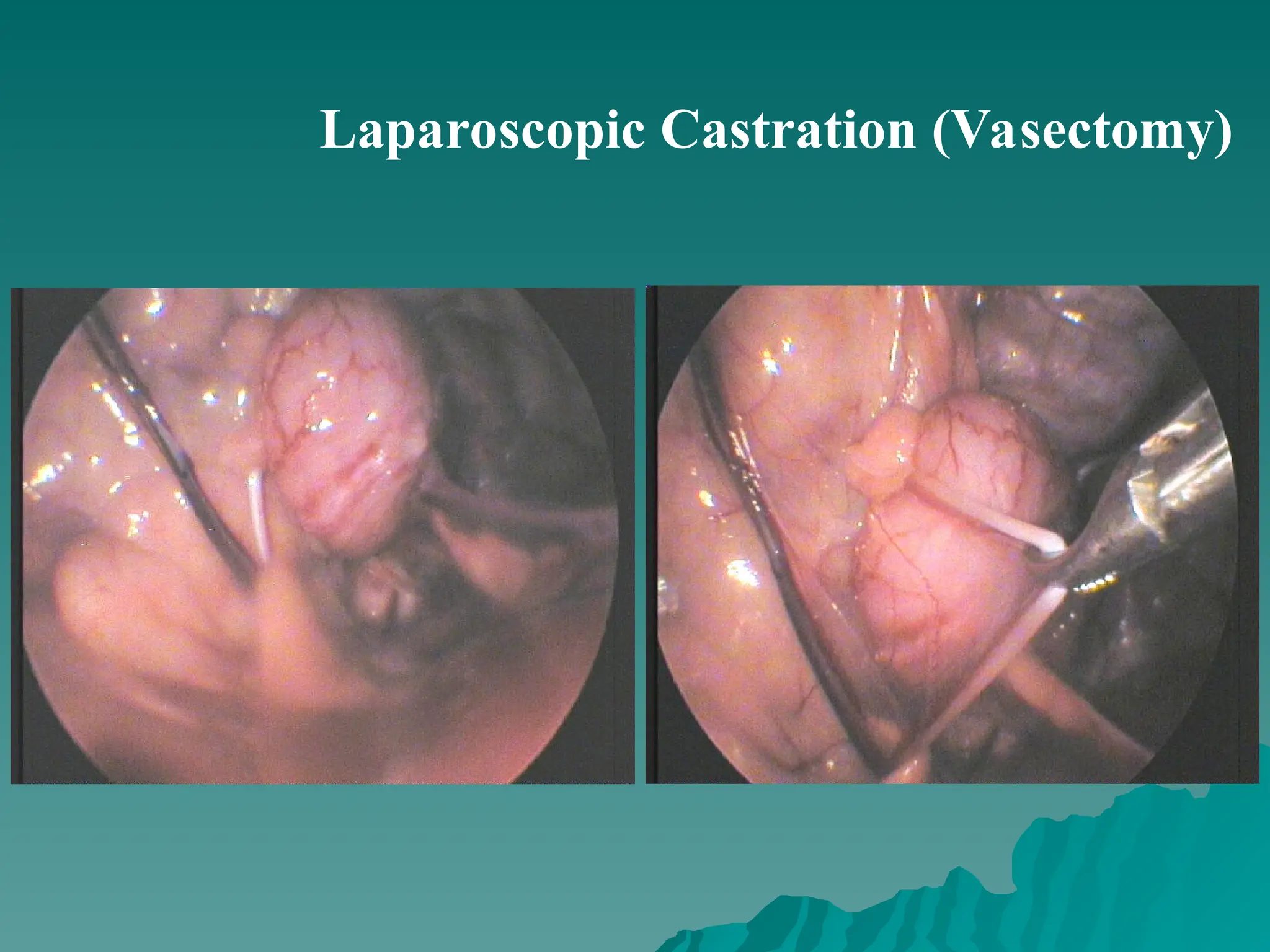 Laparoscopic Castration (Vasectomy)
 